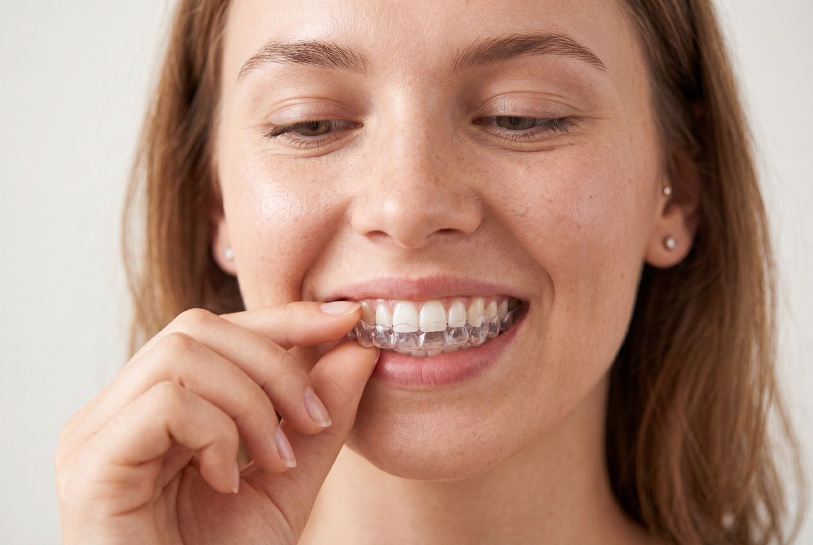 Aesthetic Freedom: Progressive Aligners
